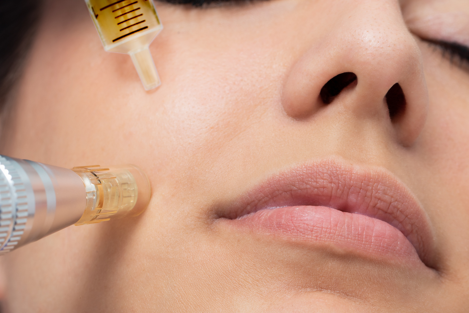Macro detail of micro needle cosmetic treatment on female cheek.